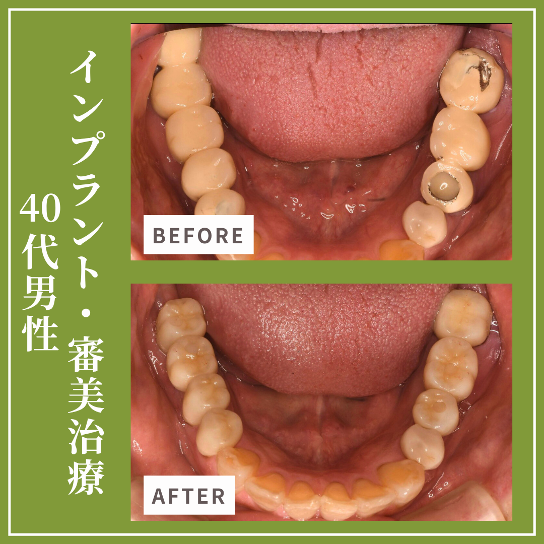 症例紹介34：インプラント治療・審美治療（40代男性）