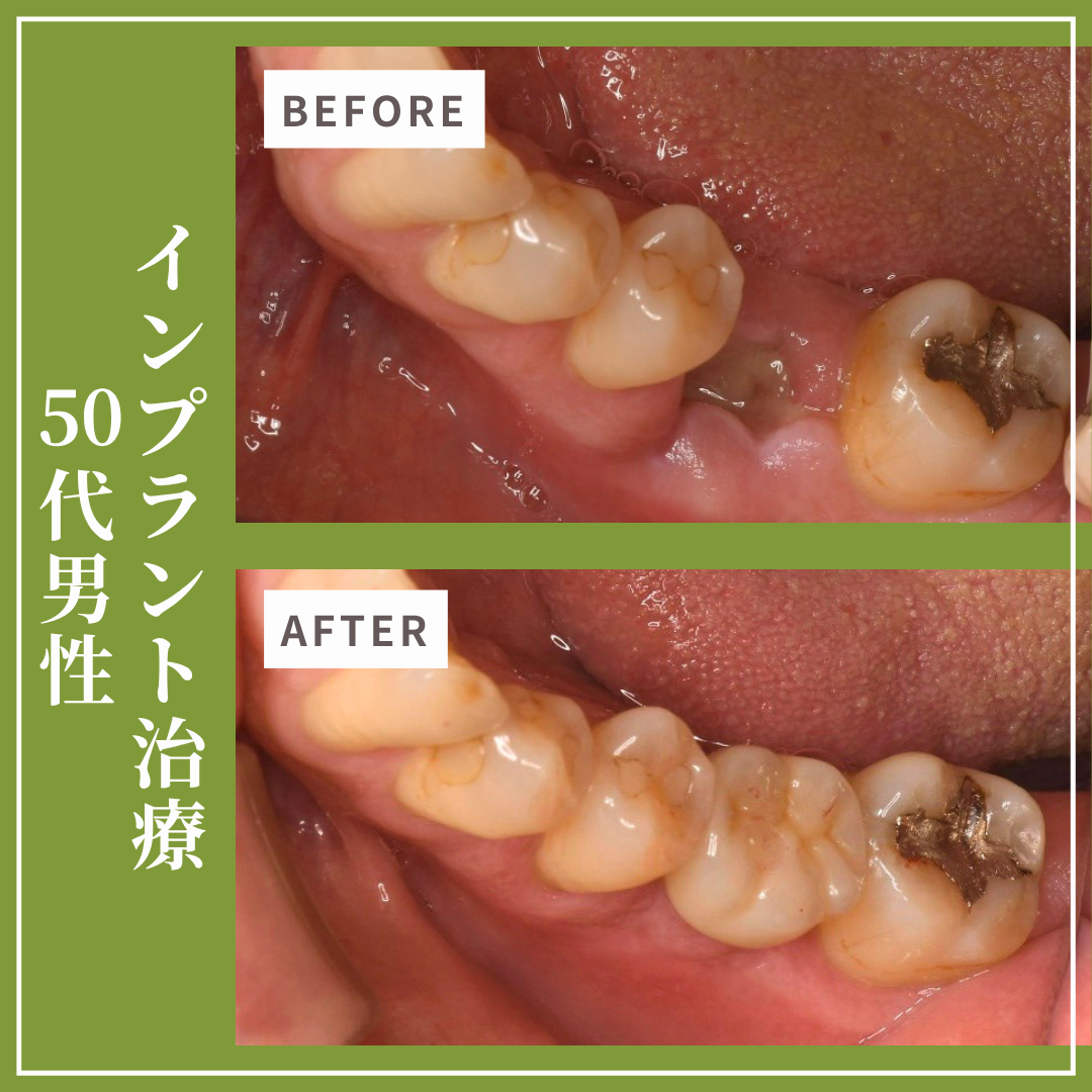 症例紹介36：インプラント治療（50代男性）