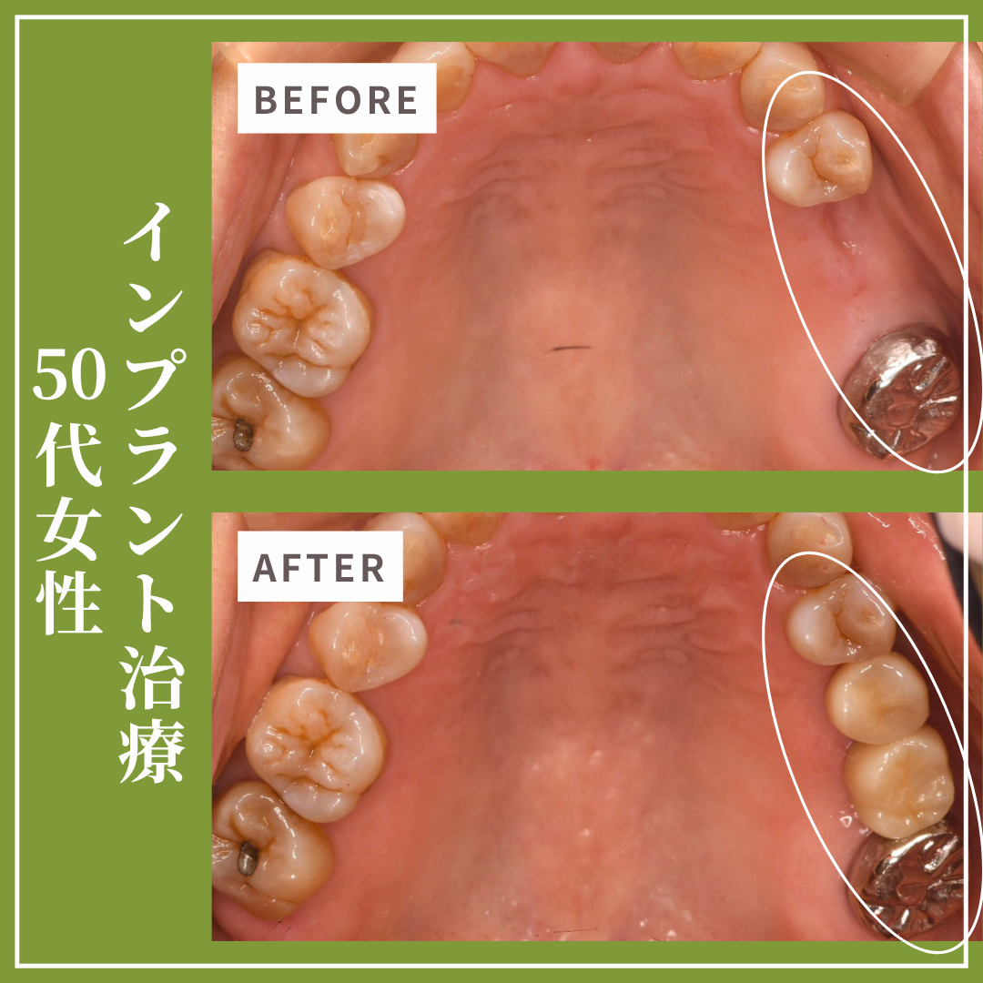 症例紹介28：インプラント治療（50代女性）