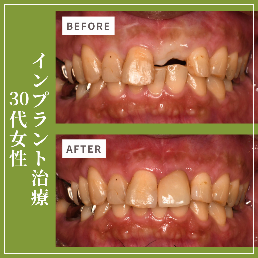 症例紹介29：インプラント治療（30代女性）