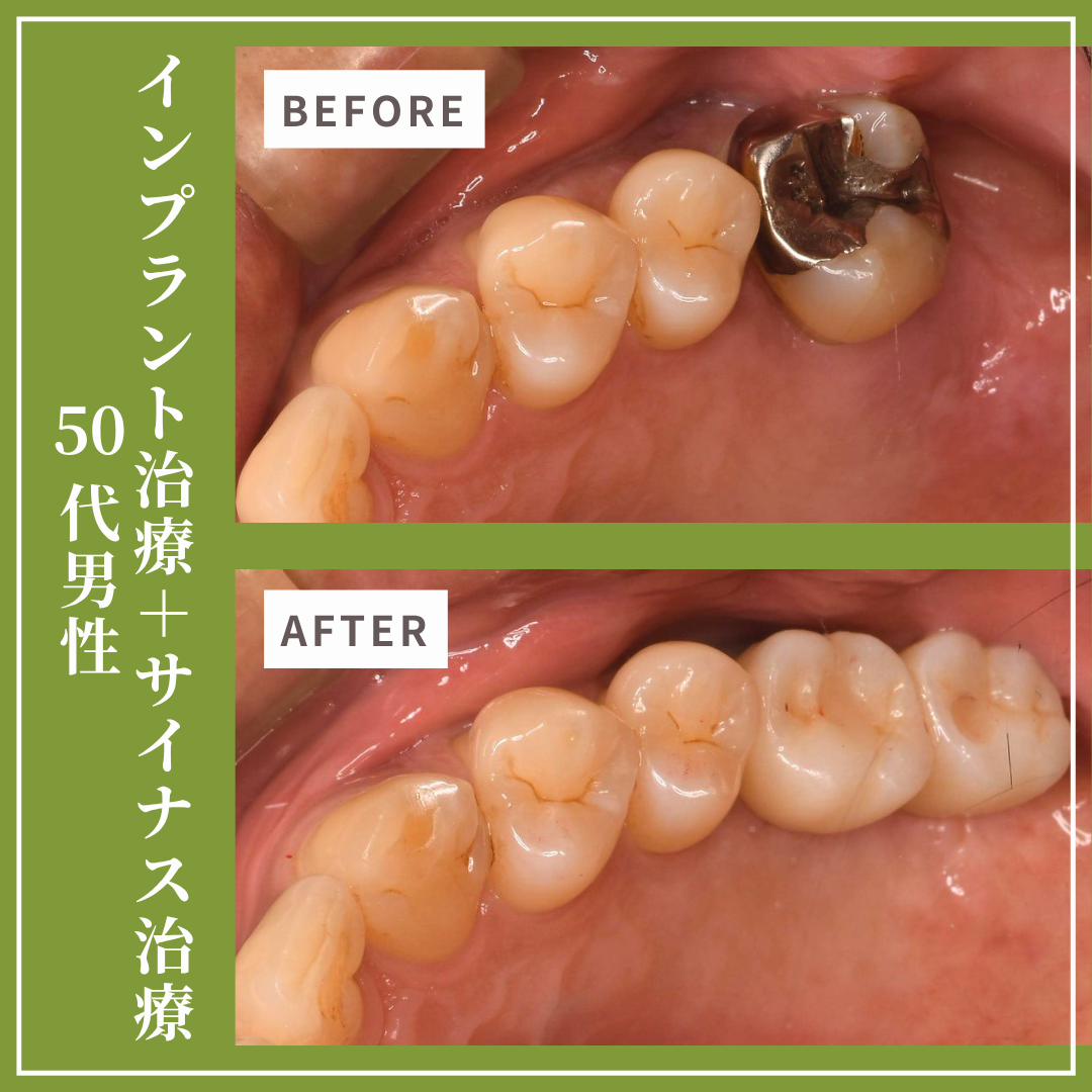 症例紹介30：インプラント治療・サイナスリフト（50代男性）
