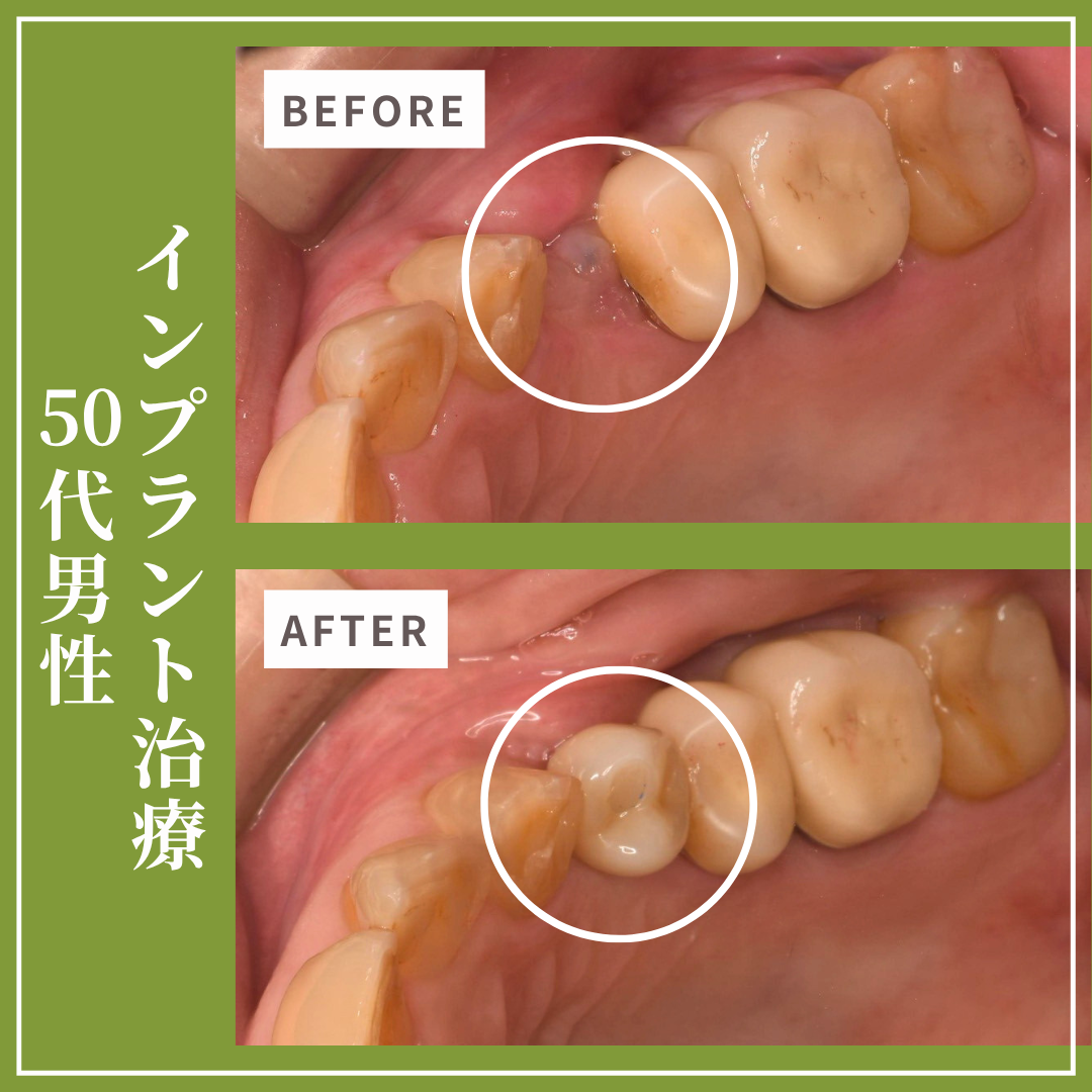 症例紹介31：インプラント治療（50代男性）