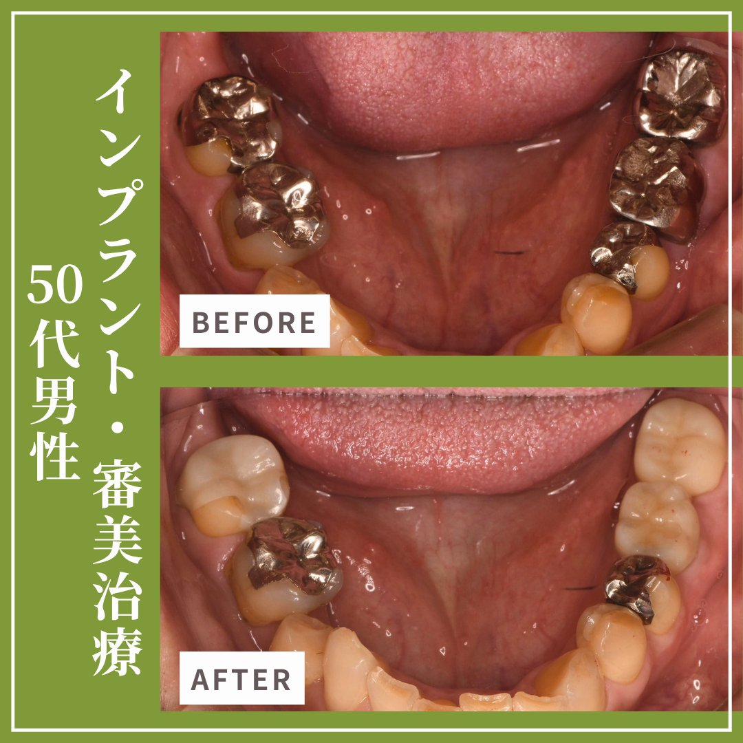 症例紹介33：インプラント治療・審美治療（50代男性）