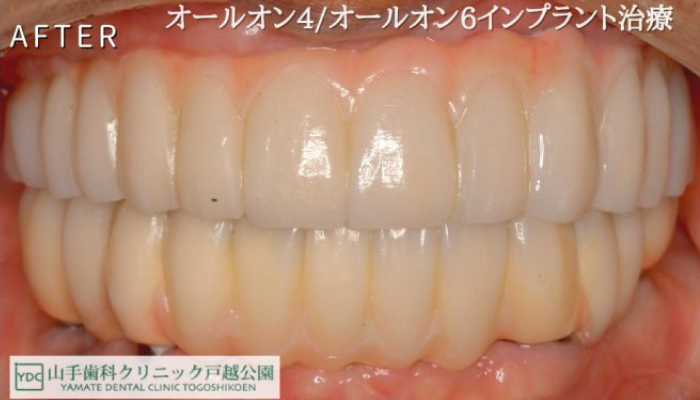 全顎インプラント治療after