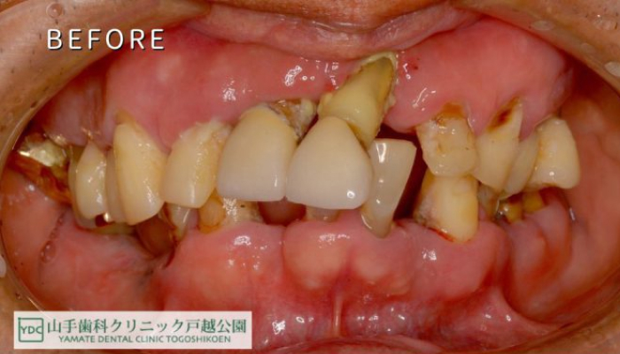 全顎インプラント治療before