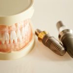 インプラントと差し歯の違いは？できる人の特徴や費用・期間を解説します