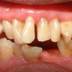 大人の歯が抜けた場合の応急処置｜歯が抜ける原因や治療法を解説します
