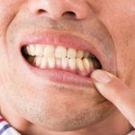 インプラント治療を受けると歯茎が黒くなる？5つの原因と治療法を紹介します