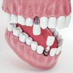 前歯のインプラントは失敗しやすい？ 失敗例から見る注意点と対処法を解説