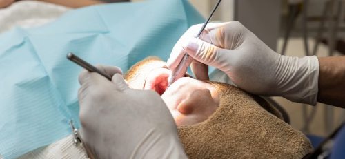 前歯インプラントの治療期間と計画