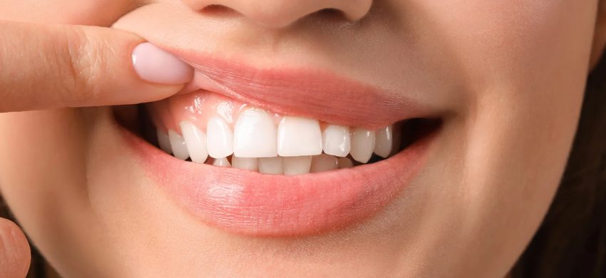 前歯インプラントの歯茎への影響とケア