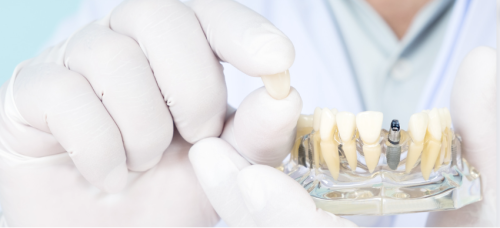 長期的な前歯インプラントの成果