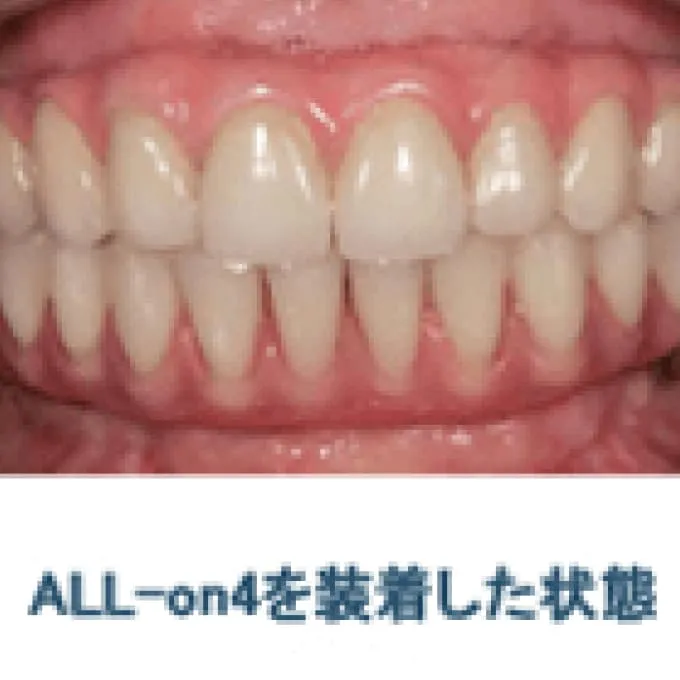 3. その日のうちに仮歯を入れ、機能させる(即時荷重インプラント)